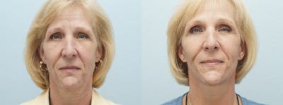 Facelift Surgery Before & After Gallery - Patient 47149498 - Image 1