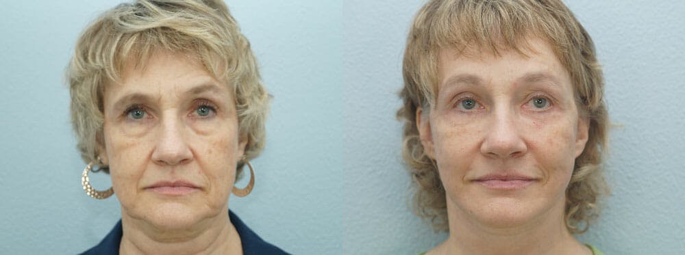 Facelift
