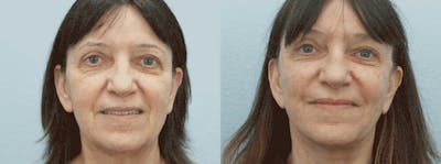 Facelift Surgery Gallery - Patient 47149502 - Image 1