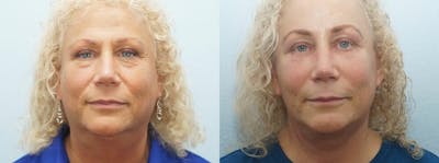 Facelift Surgery Before & After Gallery - Patient 47149506 - Image 1