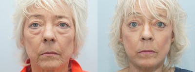 Facelift Surgery Before & After Gallery - Patient 47149507 - Image 1