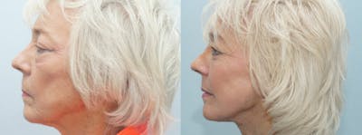 Neck Lift Before & After Gallery - Patient 49149633 - Image 1