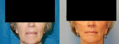 Facelift Surgery Before & After Gallery - Patient 47149509 - Image 1