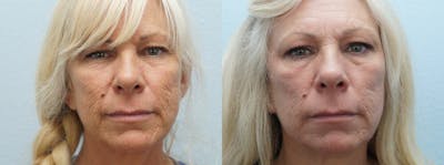 Laser Resurfacing  Before & After Gallery - Patient 47149648 - Image 1