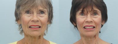 Laser Resurfacing  Before & After Gallery - Patient 47149652 - Image 1