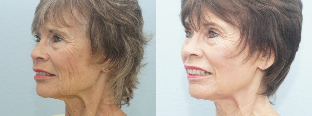 CO2 Laser Resurfacing