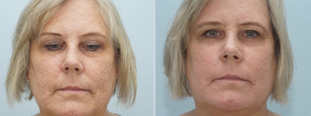 CO2 Laser Resurfacing