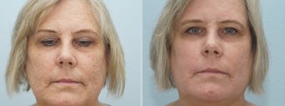 Laser Resurfacing  Before & After Gallery - Patient 47149653 - Image 1