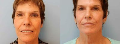 Laser Resurfacing  Before & After Gallery - Patient 47149655 - Image 1