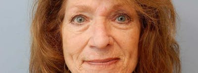 Mohs Reconstruction Before & After Gallery - Patient 47149793 - Image 1