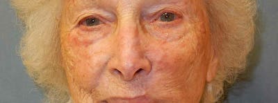 Mohs Reconstruction Before & After Gallery - Patient 47149796 - Image 1