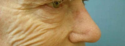 Mohs Reconstruction Before & After Gallery - Patient 47149797 - Image 1