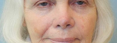 Mohs Reconstruction Before & After Gallery - Patient 47149798 - Image 1