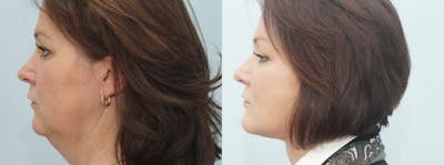 Neck Lift Before & After Gallery - Patient 47149801 - Image 1