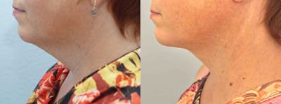 Neck Lift Before & After Gallery - Patient 47149802 - Image 1
