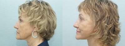 Neck Lift Before & After Gallery - Patient 47149805 - Image 1