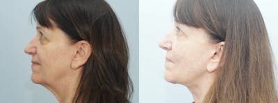 Neck Lift Before & After Gallery - Patient 47149806 - Image 1
