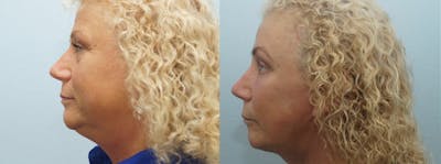 Neck Lift Before & After Gallery - Patient 47149812 - Image 1