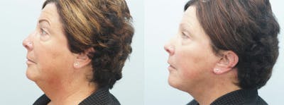 Neck Lift Before & After Gallery - Patient 47149819 - Image 1
