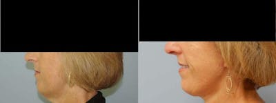 Neck Lift Before & After Gallery - Patient 47149820 - Image 1