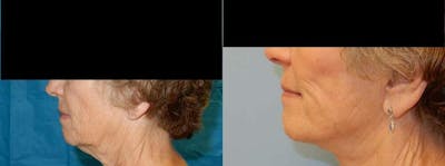 Neck Lift Before & After Gallery - Patient 47149821 - Image 1