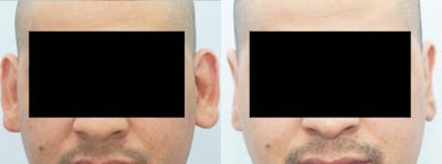 Otoplasty Before & After Gallery - Patient 47149822 - Image 1
