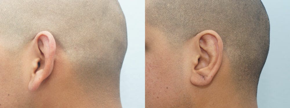 Otoplasty