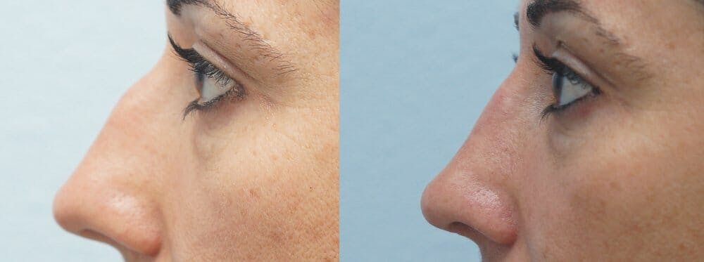 Rhinoplasty