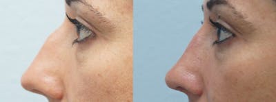 Rhinoplasty  Before & After Gallery - Patient 47149826 - Image 1