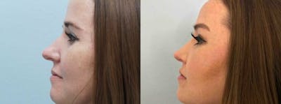 Rhinoplasty  Before & After Gallery - Patient 47149827 - Image 1