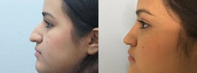 Rhinoplasty  Before & After Gallery - Patient 47149830 - Image 1