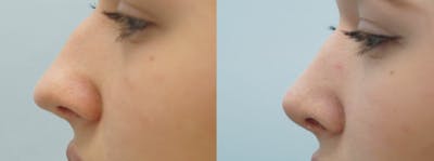 Rhinoplasty  Before & After Gallery - Patient 47149834 - Image 1