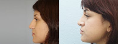 Rhinoplasty  Before & After Gallery - Patient 47149836 - Image 1