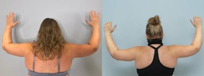 Arm Lift Before & After Gallery - Patient 47178647 - Image 1
