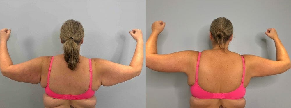 Arm Lift