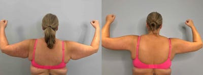 Arm Lift Before & After Gallery - Patient 47250657 - Image 1