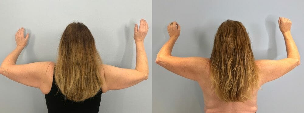 Arm Lift