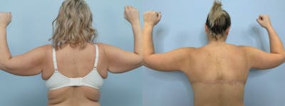 Arm Lift Before & After Gallery - Patient 47252957 - Image 1