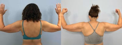 Arm Lift Before & After Gallery - Patient 47252958 - Image 1
