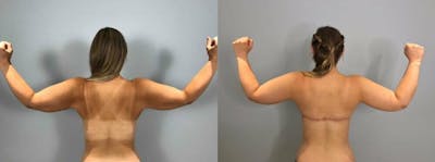 Arm Lift Before & After Gallery - Patient 47252960 - Image 1