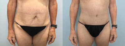Body Lift Before & After Gallery - Patient 47252976 - Image 1