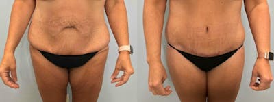 Body Lift Before & After Gallery - Patient 47252978 - Image 1