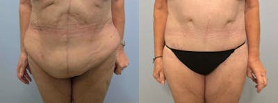 Body Lift Before & After Gallery - Patient 47252980 - Image 1
