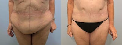 Body Lift Before & After Gallery - Patient 47252980 - Image 1