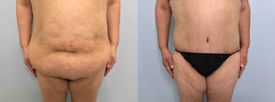 Body Lift Before & After Gallery - Patient 47252981 - Image 1