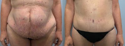 Body Lift Before & After Gallery - Patient 47252982 - Image 1