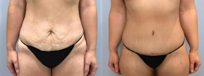 Body Lift Before & After Gallery - Patient 47252985 - Image 1