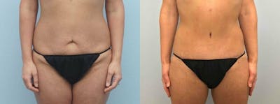 Body Lift Before & After Gallery - Patient 47252988 - Image 1