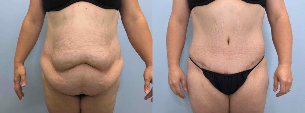 Body Lift