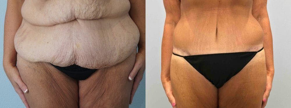 Body Lift